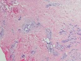 Image result for Erysipeloid