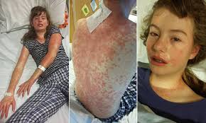 Mystery illness leaves Gloucestershire girl bleeding from the mouth