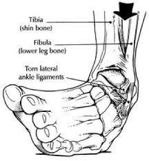 Because a serious midfoot sprain can threaten the career of professional athletes or dancers, they often need to follow special treatment and rehabilitation re. Sprained Ankle From A Twist Toronto Orthotics Located In North York
