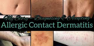 Dr visit last thursday, contact dermatitis. My Personal Story Of Allergic Contact Dermatitis Diagnosis And Acceptance Part 1 Heather Mangieri Nutrition