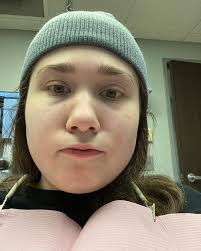 Just had my bottom wisdom teeth taken out. 🥺