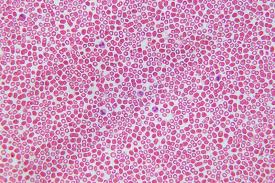 More info on cell staining. Blood Cells Under Microscope View For Education Stock Photo Image Of Cancer Blood 124378938