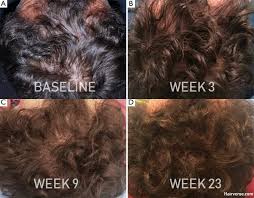 Some drugs encourage hair regrowth after chemotherapy, but the results vary. Stem Cell Therapy For Hair Loss Potential And Limitations Hairverse