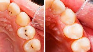 Karies Fruherkennung Vermeidet Schmerzen Casa Dental Casa Dental De