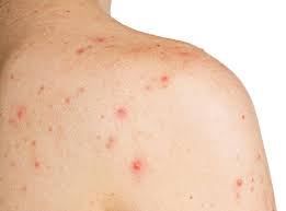 Masalah jerawat di badan bisa timbul akibat berbagai faktor, salah satunya cuaca. 10 Cara Atasi Jerawat Badan Salah Satunya Guna Air Sirih Remaja