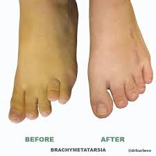 Pin On Brachymetarsia A Condition In Which I Suffered With For Years