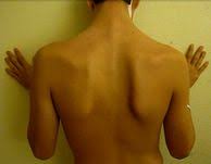 The incubation period is the time between being exposed to the virus and the onset of symptoms. Winged Scapula Physiopedia