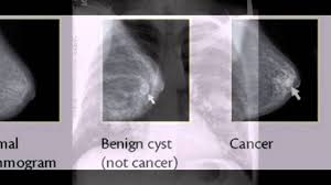 Often there is no external sign of breast cancer. Breast Cancer X Ray Youtube