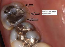 Broken Tooth Becomes A Smile Makeover Cary Family Dental Dr Allan Acton