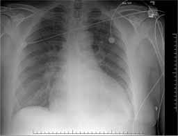 With the possible exception of some stainless 416 barrel offered at aim surplus, i would not partake. Congestive Heart Failure And Acute Pulmonary Edema Cardiovascular Disease Tintinalli S Emergency Medicine Just The Facts 3ed