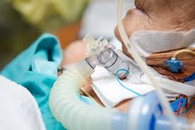 Image result for Tracheostomy