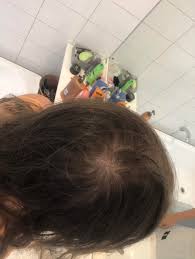 Down from either your mother or father—if you've got a grandmother or aunt on either side of your family with thinning hair, there's a chance. What Type Of Hair Loss Is This I M 20 F And Have Started Noticing Hair Thinning In The Last Few Months And Now Have This Bald Spot At The Back Of Head