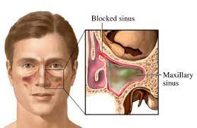 Blocked Sinus Remedy That Really Works Home Remedies For Congestion Home Remedies For Sinus Sinus Drainage