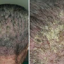 Image result for scabies in the groin area