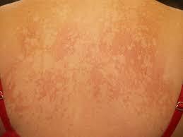 This is then followed, days to weeks later, by a rash of many similar but smaller round or oval lesions, mainly on the trunk and upper limbs. Figure Pityriasis Versicolor Contributed By Dermnetnz Statpearls Ncbi Bookshelf