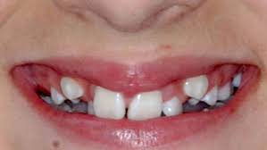 Como Solucionar El Problema De Los Dientes Sin Espacio Grup Dr Blade