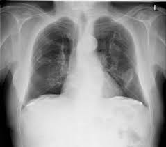 Department of radiology, university of british. Pleural Plaques Radiology Case Radiopaedia Org