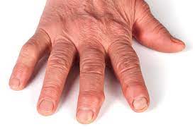 Poliartrita reumatoida referat pentru asistent medical generalist generalitati, tratament, cazuri de pacienti cu poliartita reumatoida , bibliografie 1. Totul Despre Poliartrita Reumatoida Cauze Simptome Si Tratament Centrokinetic