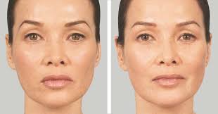 Sculptra has unique injection requirements and should only be used by a trained healthcare practitioner. Sculptra Aesthetic Injections Pioneer Valley Plastic Surgery Springfield Ma