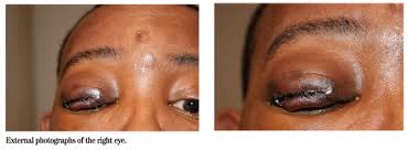 Flip your animated gifs to optimal size without losing quality in seconds. Wills Eye Resident Case Series