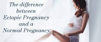 Patients commonly present with lower abdominal/pelvic pain, with or without vaginal bleeding. Difference Between Ectopic Pregnancy And A Normal Pregnancy
