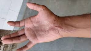 Anastomosis is most commonly used to secure upper and lower sections of the large intestine together after a middle. Electrodiagnostic Description Of A Rare Variant Of Berrettini Anastomois A Case Report Sciencedirect