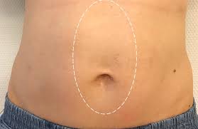 More images for umbilical hernia pictures in women » Young Women After Emilos Umbilical Hernia And Rectus Diastasis Repair Download Scientific Diagram