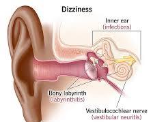 Image of Dizziness