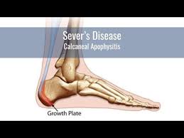 Image result for Calcaneal Apophysitis