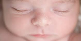 Milien Bei Babys Ursachen Und Behandlung Babyartikel De Magazin