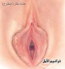 صور غشاء بكارة مفتوح 2014 صور غشاء بكارة بالشرح مفتوح
