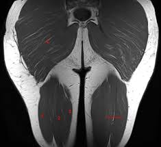 Axial thigh (upper) this is an axial image of the upper thighs in a male. Mri Of The Thigh Detailed Anatomy Superior Part W Radiology