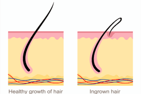 Use a sterile needle, inserting it under hair loops, to gently lift embedded hair tips. Ingrown Hair Overview Symptoms Causes Proven Remedies Factdr