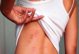Where Do Bed Bugs Hide On Your Body?
