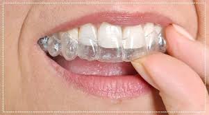 Jul 06, 2021 · another possible way to straighten crooked teeth without braces is with a retainer. Want To Straighten Your Teeth Without Braces