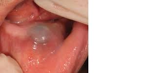A swollen tongue can be accompanied with other symptoms depending with the underlying cause of your condition. Racgp Common Causes Of Swelling In The Oral Cavity