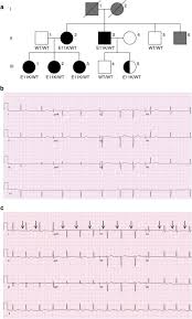 Well, chen pi pi lost but he did manage to buy time for ning que and mo shan shan to repair the shocking god formation. A Mutation In The Atrial Specific Myosin Light Chain Gene Myl4 Causes Familial Atrial Fibrillation Nature Communications