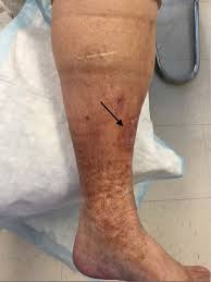 Areas that are exposed to sun such as the forehead, temples and neck are most commonly affected. Hypertrophic Lichen Planus Mimicking Squamous Cell Carcinoma The Importance Of Clinicopathologic Correlation Jaad Case Reports