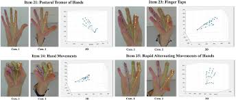 Image result for Rapid Alternating Movements