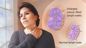 Limfoma atau kanker kelenjar getah bening adalah sejenis kanker. Obat Herbal Kanker Kelenjar Getah Bening Stadium 1 Limfoma11 S Diary