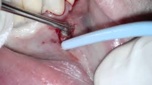 Should you require dental implants. Soft Tissue Biopsy Youtube