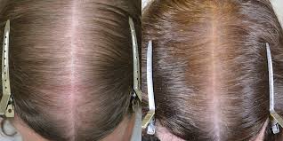 Hair loss, chronic fatigue and spironolactone are killing me part 2. Spironolactone Hair Restoration Of The South New Orleans La