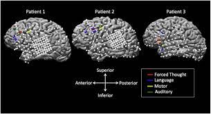 Epilepsy, or seizure disorder, is a chronic neurological disorder marked by sudden and unpredictable seizures. Forced Conceptual Thought Induced By Electrical Stimulation Of The Left Prefrontal Gyrus Involves Widespread Neural Networks Epilepsy Behavior