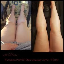 Dr Witte Mein Held Liposuktionen In Der Lipoclinic In Mulheim An Der Ruhr Teil 2 Liposuktion Lipodem Mode Lipodem