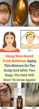 Each Person Dreams Of Healthy Shiny Dandruff Free Hair With Less Hair Fall It Is Not Possib Baking Soda Shampoo Baking Soda For Hair Baking Soda Dry Shampoo