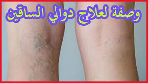 علاج دوالى ااساقين دكتور مازن السقا. Ø¯ÙˆØ§Ù„ÙŠ Ø§Ù„Ø³Ø§Ù‚ Ø¨Ø§Ù„Ø§Ù†Ø¬Ù„ÙŠØ²ÙŠ
