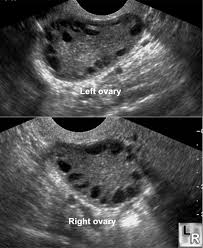 Such cysts in ovaries is called pco. What S Polycystic Ovarian Syndrome Scienceline