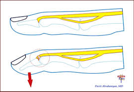 Thickenings of the flexor sheath are. Minor Care Series Finger Tendon Injuries Taming The Sru