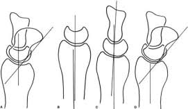Adolescent with radiographic evidence of kienbock's and progressive wrist pain. The Lichtman Classification For Kienbock S Disease An Assessment Of Reliability Journal Of Hand Surgery