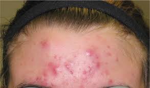The nodules may become suppurative or hemorrhagic. Diagnosis And Treatment Of Acne American Family Physician